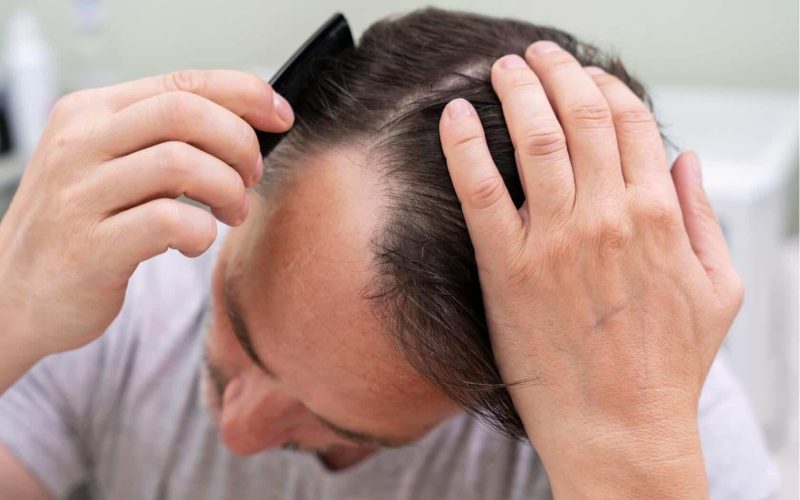 Steroid Hair Loss