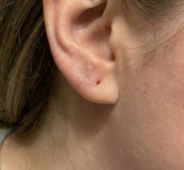 after kleiod removal 3