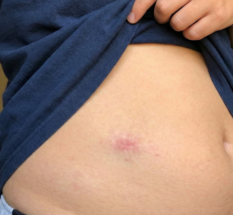 after skin lesion treatment 3