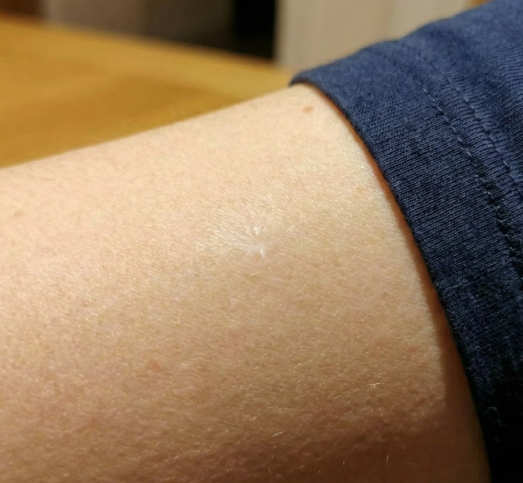 after skin lesion treatment