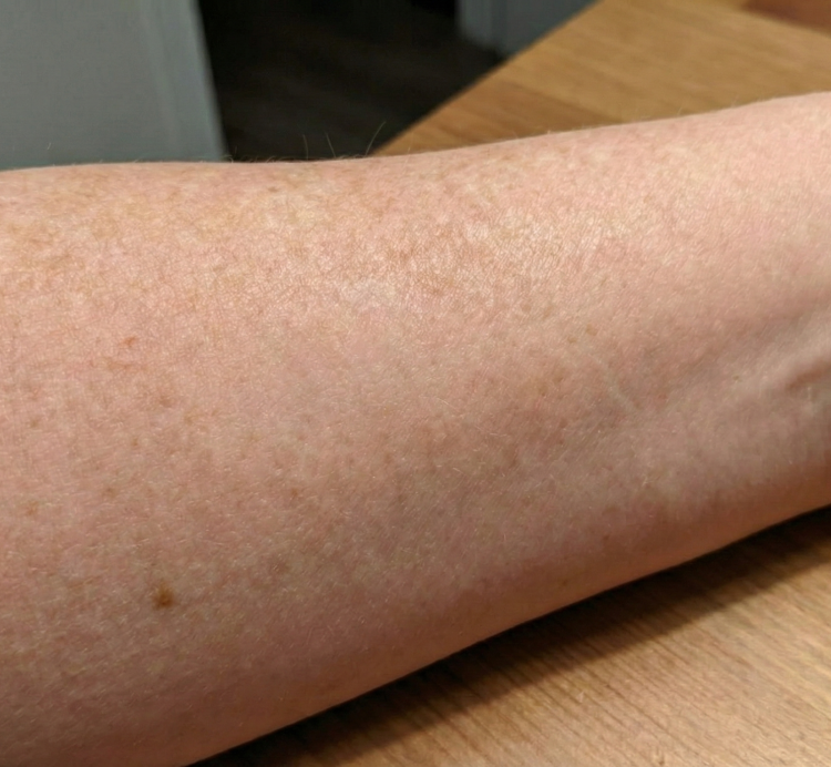 after treatment skin cancer 1