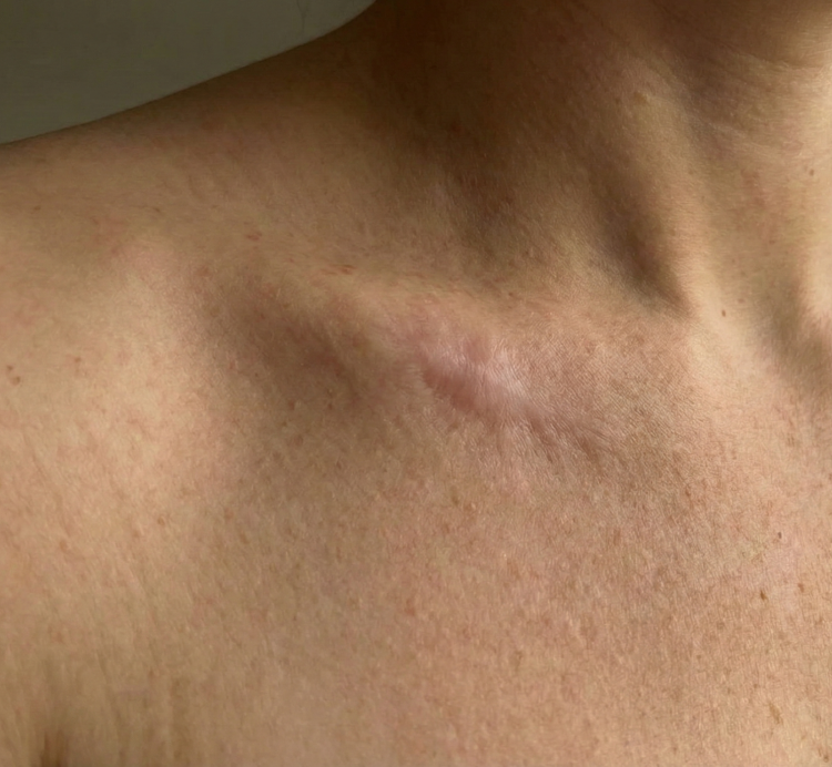 after treatment skin cancer 3