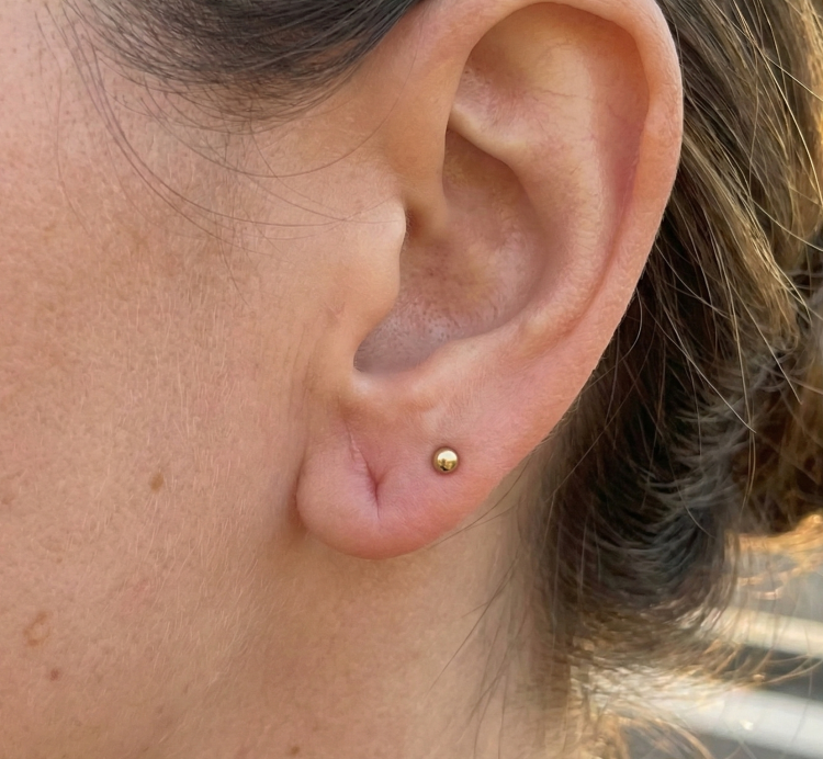 after treatment split ear lobe 1