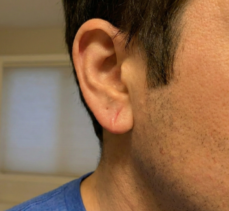 after treatment split ear lobe 3