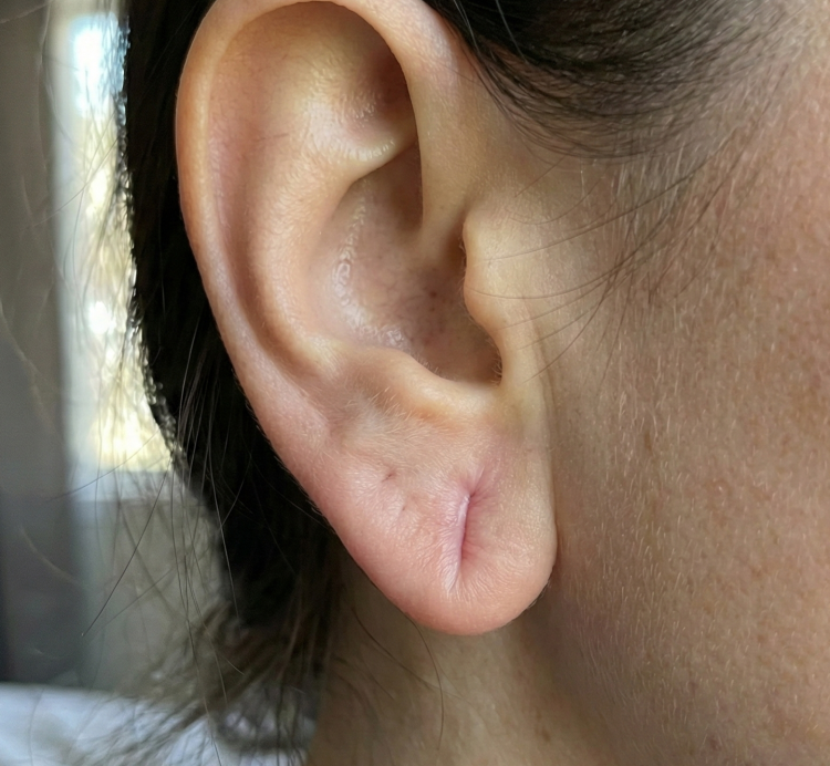 after treatment stretched ear lobe 1