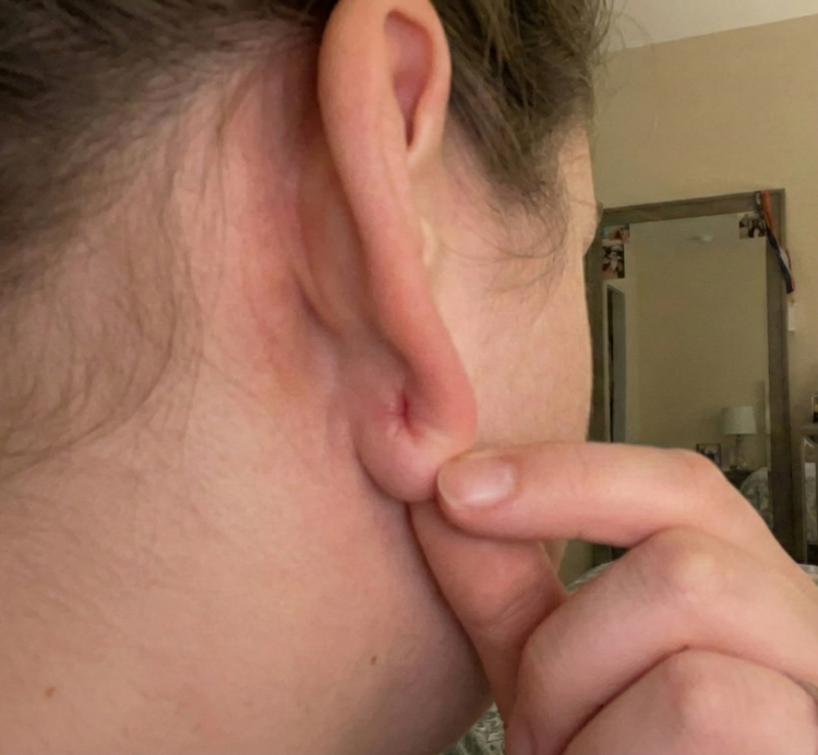 after treatment stretched ear lobe 2