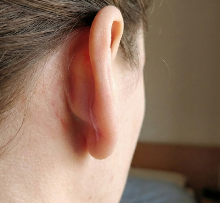 after treatment stretched ear lobe 3