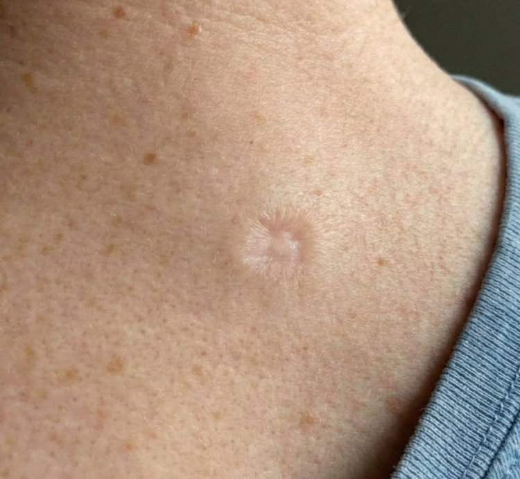 aftere treatment skin cancer 2