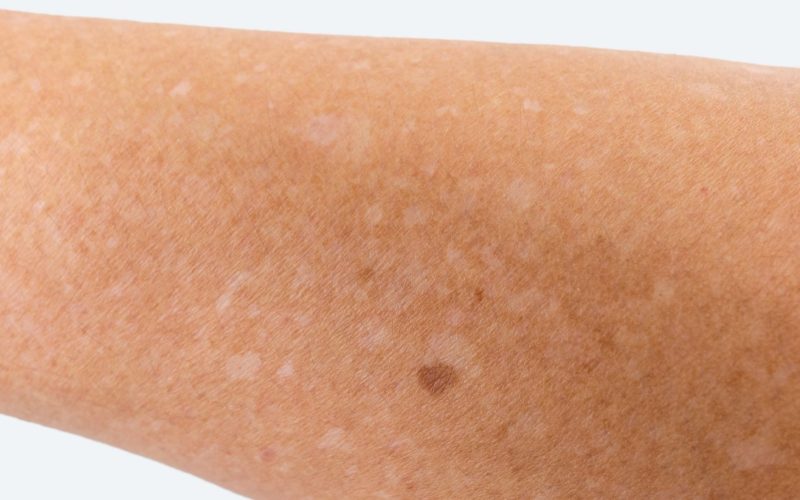 arms with Idiopathic guttate hypomelanosis