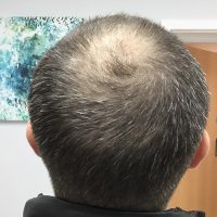 balding crown before transplant