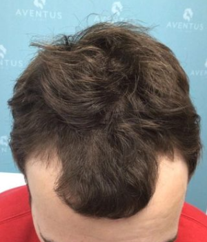 before non surgical hair treatment 2