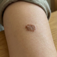 before skin lesion treatment 2