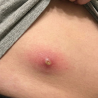 before skin lesion treatment 3