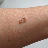 before treatment skin cancer 1