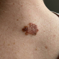 before treatment skin cancer 2