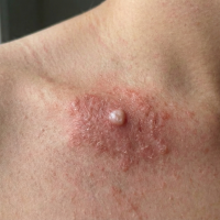 before treatment skin cancer 3