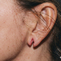 before treatment split ear lobe 1