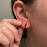 before treatment split ear lobe 2