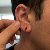 before treatment split ear lobe 3