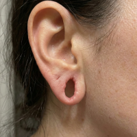 before treatment stretched ear lobe 1