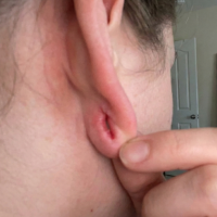 before treatment stretched ear lobe 2