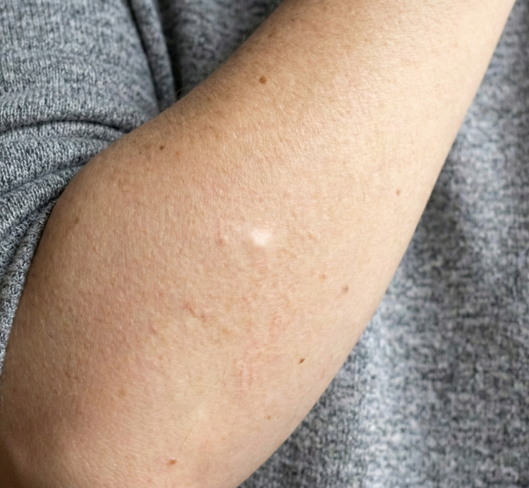 cherry angioma after 2