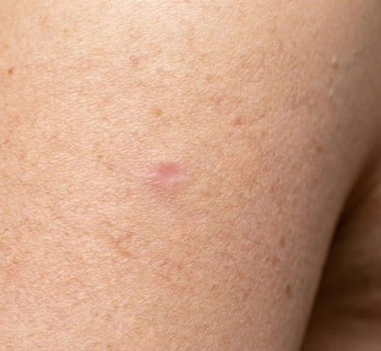 cherry angioma after 3