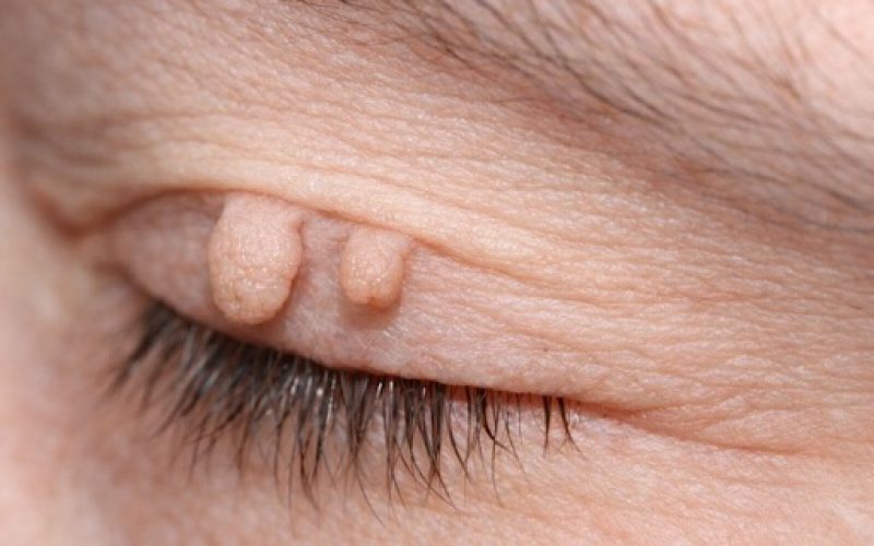 eyelid skin tags