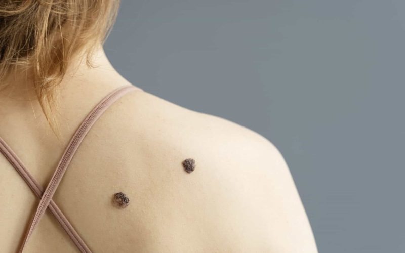 featured-image-of-Mole-Changes-Colour-or-Shape-scaled