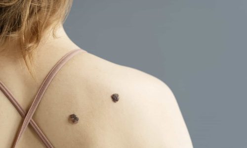 Mole Changes Colour or Shape