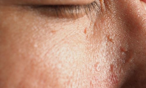flat warts on the face