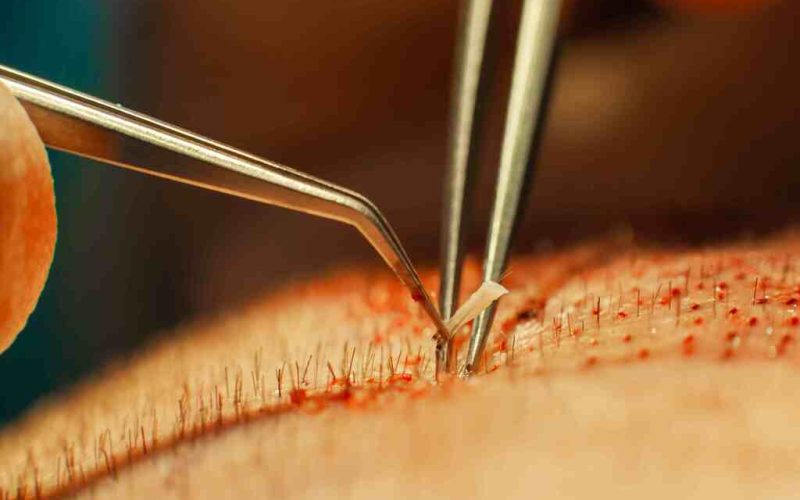 hair-transplant-infection