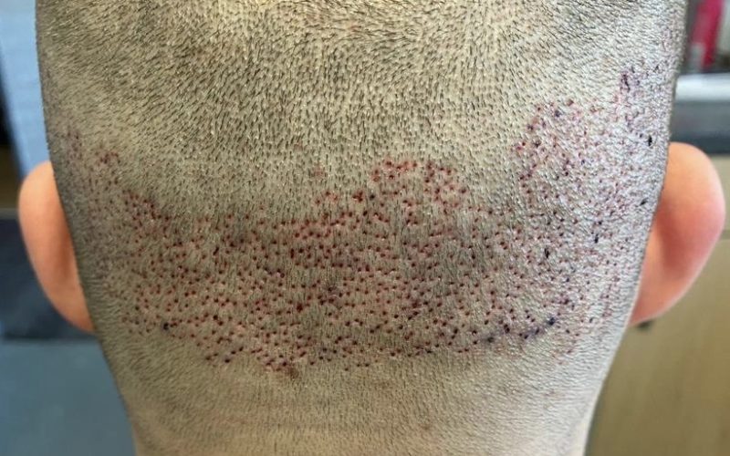 hair transplant scar