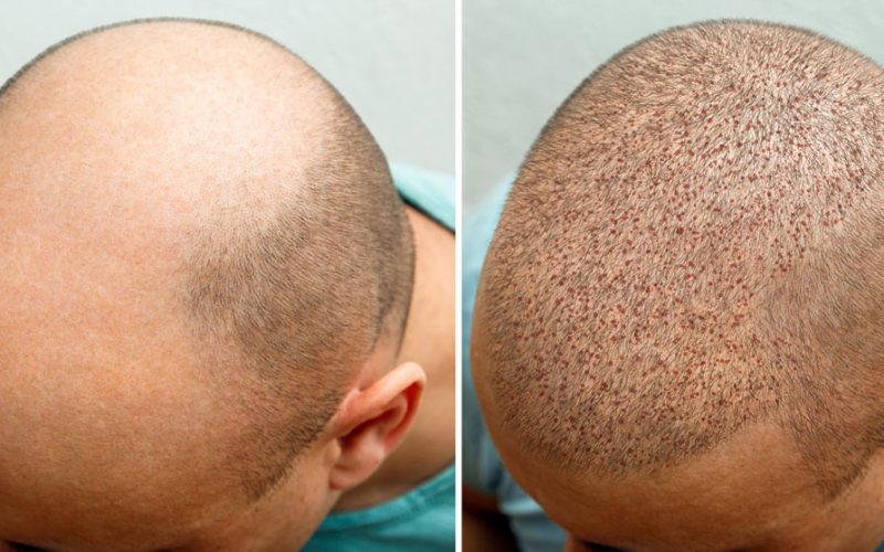 Hair Transplant Timeline