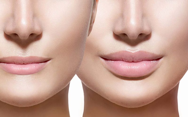 how-long-does-lip-filler-last-scaled