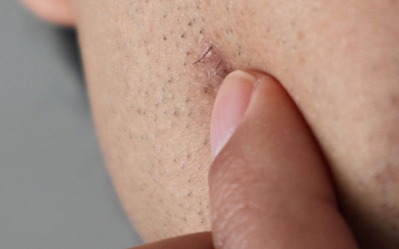 ingrown hair in beard