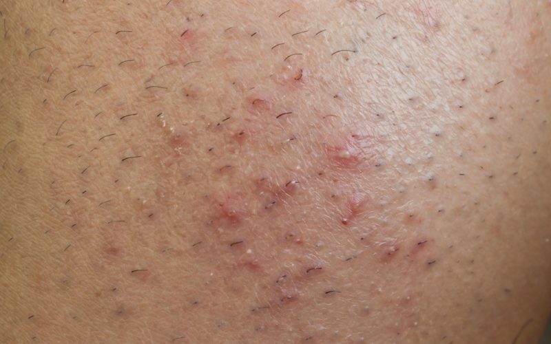 ingrown hair