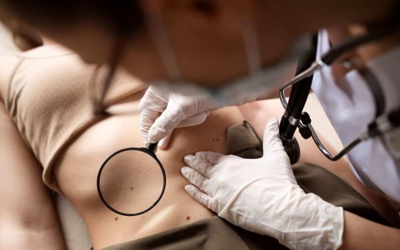 mole removal treatment