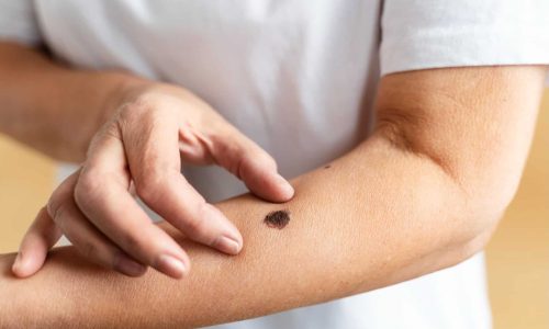 seborrheic keratosis