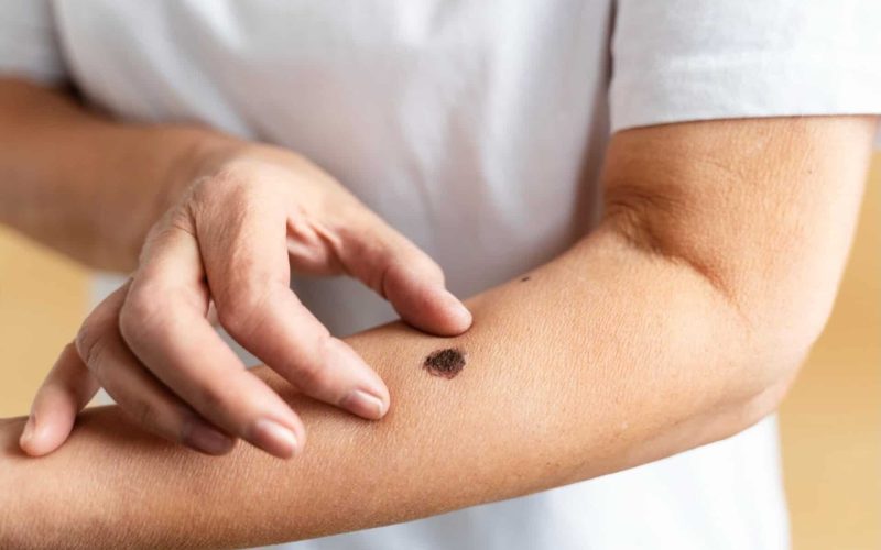 seborrheic keratosis